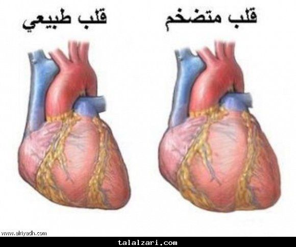 تضخم القلب - الرياض