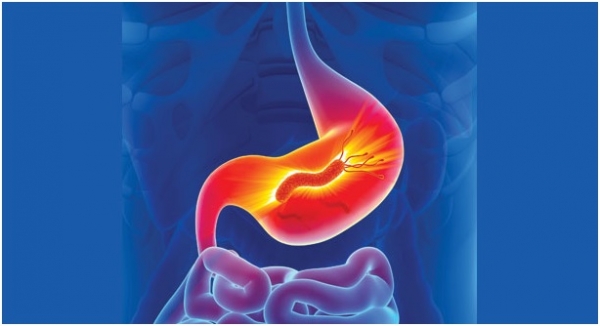 مركب في الزيوت النباتية.. يدمر الجرثومة الحلزونية المسببة لقرحة وسرطان المعدة