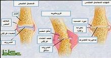 واحد في المائة من السعوديين مصابون بالتهاب المفاصل الروماتيزمي