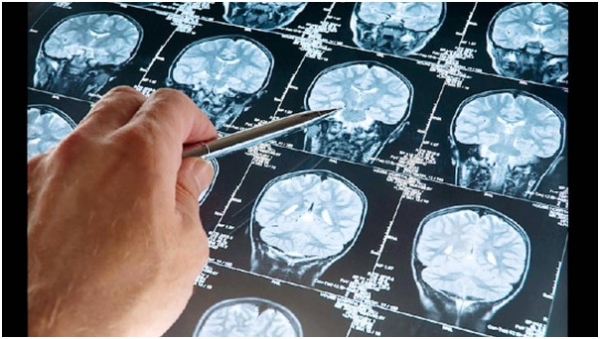 عقار جديد يثبت فعاليته في علاج أورام المخ