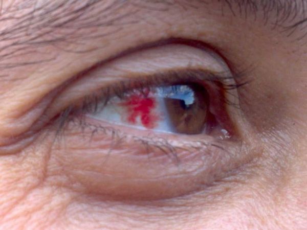 هل تعاني من هذه الأعراض الشائعة لمشاكل العين؟