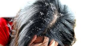 علاجات طبيعية لقشرة الشعر