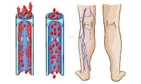 أسباب حدوث جلطات الأوردة العميقة