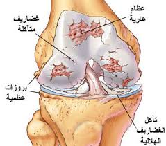 "خشونة الركبة".. علاج طبيعي أم تدخل جراحي؟