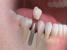 تطورات كبرى في زراعة الأسنان