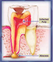 تسوس الأسنان مسبباته جينية