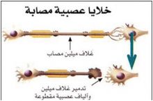 مرض التصلب اللويحي يصيب الجهاز العصبي المركزي ويضعف الجسم  