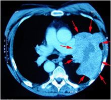 الأشعة المقطعية لسرطان الرئة قد تكون خادعة