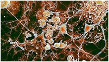 تجربة علمية لاستخدام الخلايا الجذعية لعلاج التصلب العصبي المتعدد