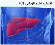  25 % من المصريين مصابون بالتهاب الكبد الوبائي "C".. وأمل بلقاح جديد