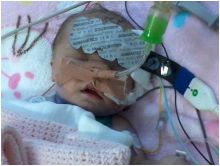 أصغر طفلة في العالم تتعافى من جراحة قلب مفتوح