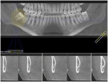  تصوير الأسنان الإشعاعي قد يؤدي إلى أورام في الدماغ