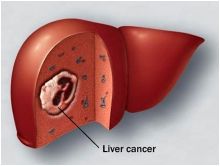  %11 من حالات سرطان الكبد ترتبط بالبدانة