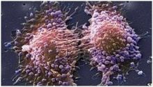  اكتشاف جين يرتبط بنمو سرطان البروستاتا