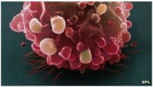اكتشاف جينين مسؤولين عن سرطان الأمعاء