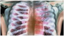  تشخيص أمراض الرئة باستخدام بصمة التنفس
