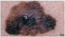 سرطان الجلد قادر على مقاومة جهاز الجسم المناعي