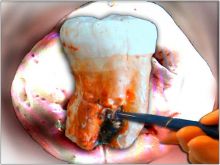هل ذوو نخور الأسنان أقل عرضة للسرطان؟