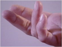 مرض تقوس الأصابع.. الأسباب وطرق العلاج