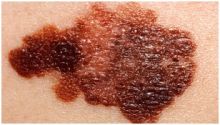تحليل للدم يساعد في اكتشاف انتشار سرطان الجلد