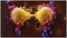 اختبار مستوى خطورة سرطان البروستاتا قد يجنب التدخل الجراحي