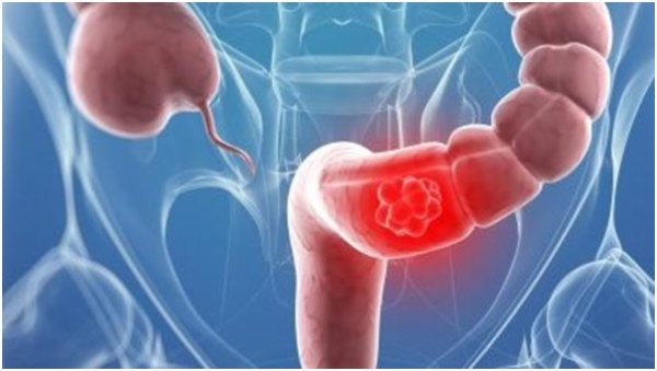 النظام الغذائي المتوازن قد يقي من سرطان الأمعاء