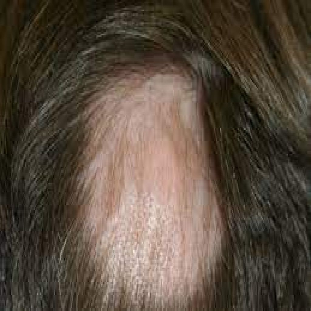 عقار يعيد نمو الشعر بالكامل لمرضى الثعلبة